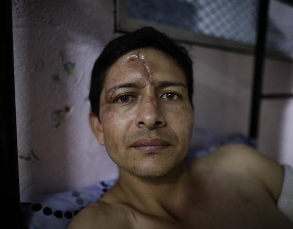 Edison Figueroa, un ecuatoriano de 29 años y sobreviviente del accidente de bus, se recupera de las heridas en un albergue católico en David, Chiriquí (Panamá).
