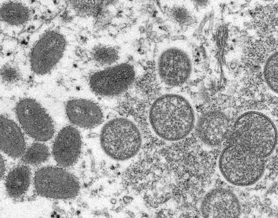 En esta imagen de 2003 de un microscopio de electrones difundida por los Centros para el Control y la Prevención de Enfermedades de Estados Unidos, se ven viriones maduros y en forma de óvalo de la viruela símica, a la izquierda, y viriones inmaduros con forma esférica, a la derecha.