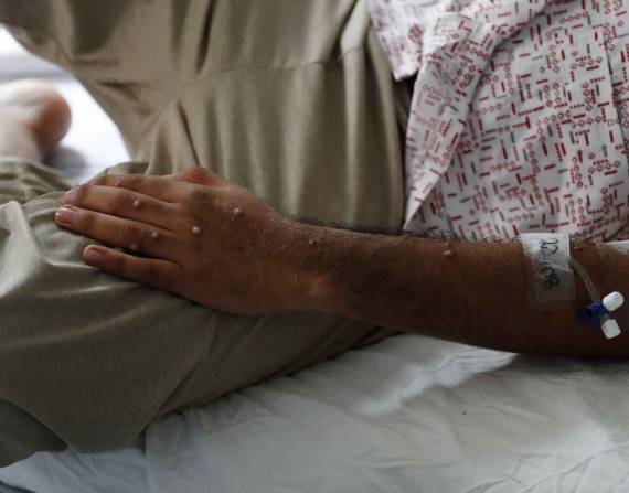 Un paciente es atendido tras ser diagnosticado con la viruela del mono, el 24 de agosto de 2022, en el hospital Cayatano Heredia, en Lima (Perú). ARCHIVO