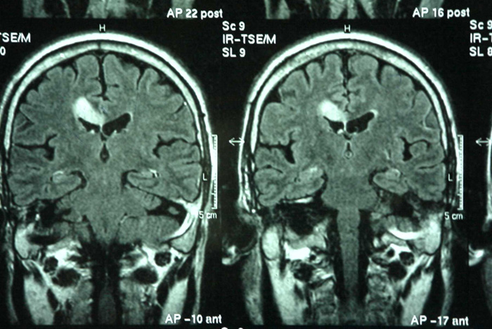 Descubren cómo el cerebro equilibra la emoción y la razón