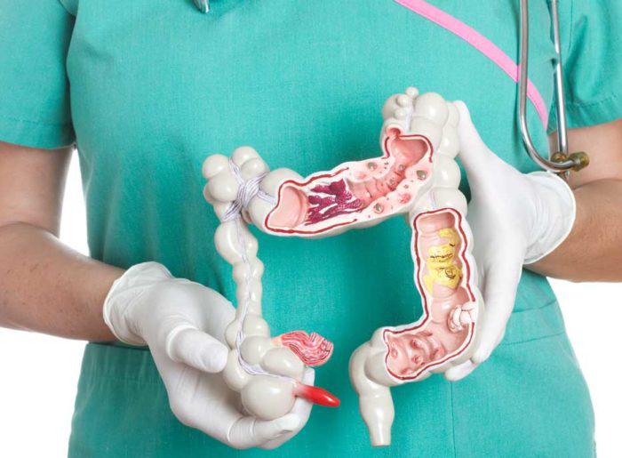 Los niveles de vitamina D en sangre son importantes para determinar el riesgo de cáncer colorrectal, según estudio