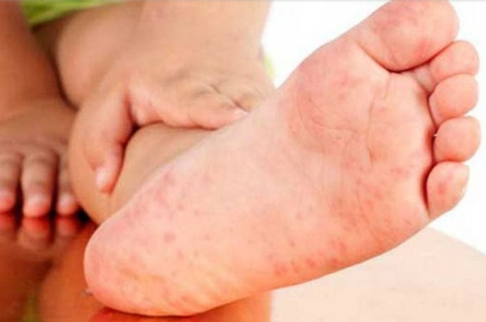 Guayaquil también registra casos de niños con síndrome de Kawasaki por Covid-19