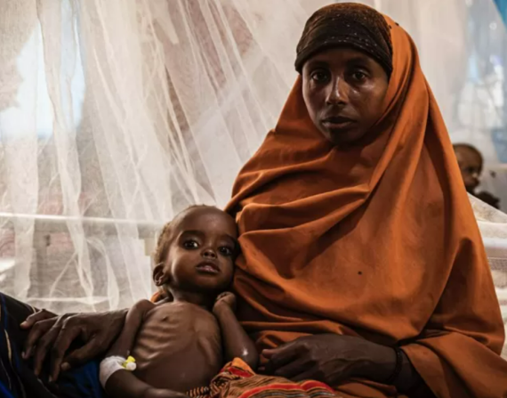Muchos niños tienen graves problemas de salud debido a la falta de alimentos en Somalia.