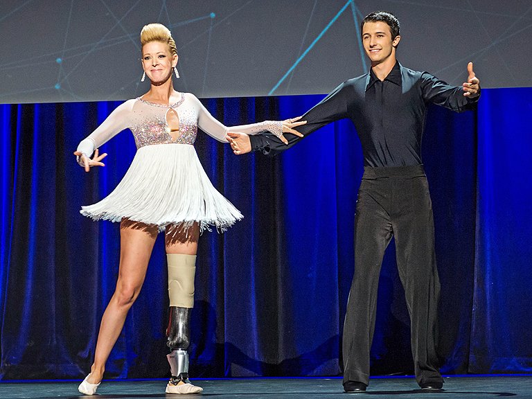 Sus sueños de bailarina renacieron gracias a una prótesis