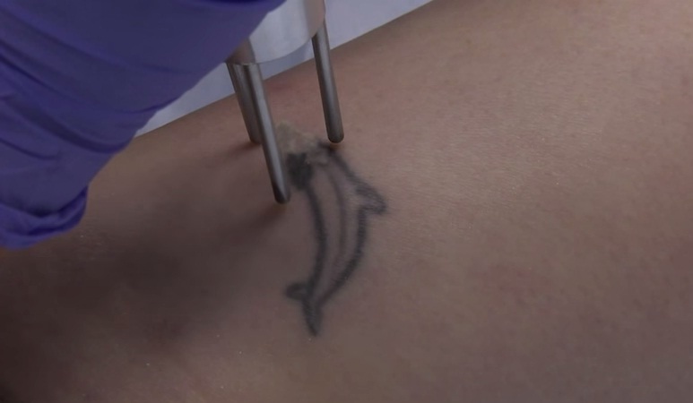 (VIDEO) Cómo el láser comienza a &#039;destatuar&#039;