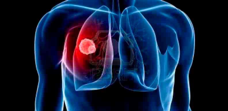 Latinoamericanos desconocen gravedad del cáncer de pulmón, según encuesta