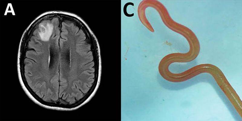 Un gusano vivo en el cerebro de una mujer y otras 4 noticias de salud que causaron impacto en 2023