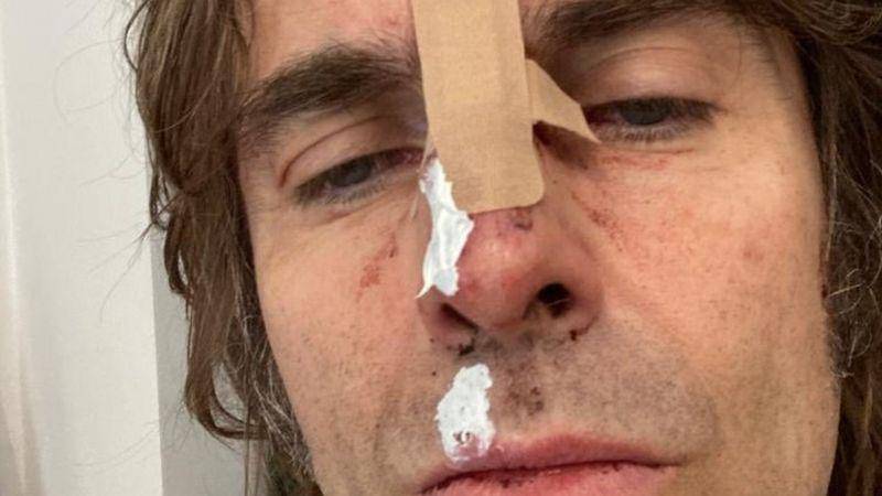 La foto que compartió Liam Gallagher, exlíder de Oasis, tras caerse de un helicóptero