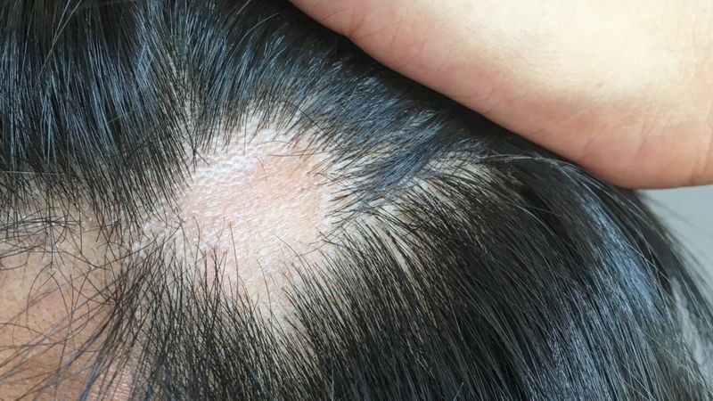 Qué causa y cómo tratar la caída del cabello que afecta a uno de cada cuatro infectados
