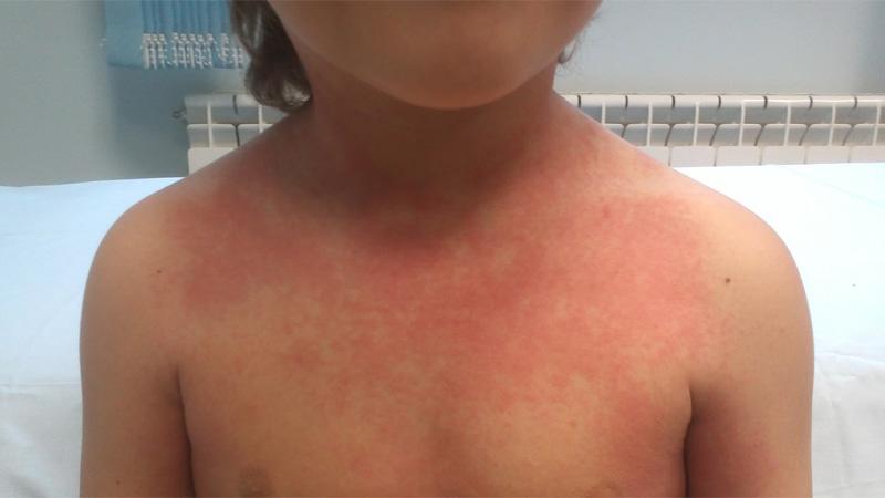 Guayaquil: Alta incidencia de casos de dengue clásico en niños