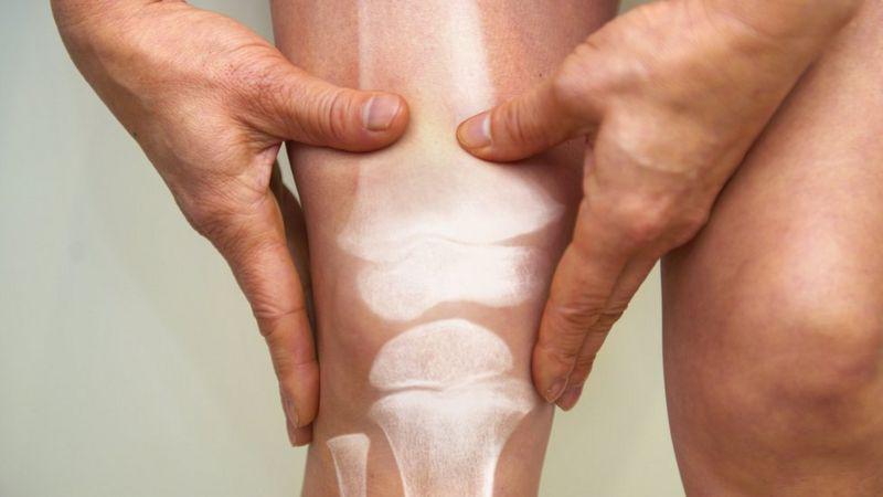 Osteoporosis masculina: la enfermedad silenciosa que cada año causa fracturas a miles de hombres en el mundo