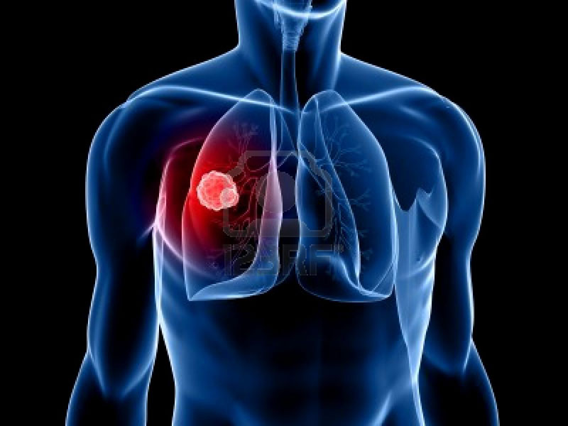 El cáncer de pulmón es ahora más mortífero que el de seno en países ricos