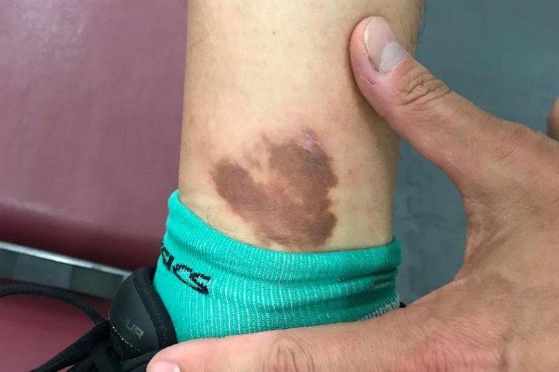 Un pequeño hematoma en el tobillo resultó ser un agresivo cáncer