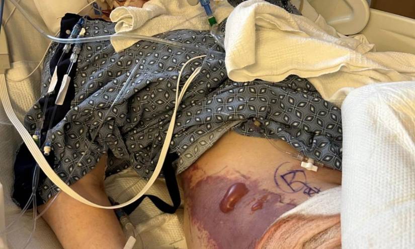 Un brote infeccioso causado por la bacteria 'Vibrio vulnificus', comúnmente conocida como la bacteria come carne, ha encendido las alarmas entre las autoridades de salud y la población en varios estados de Estados Unidos.