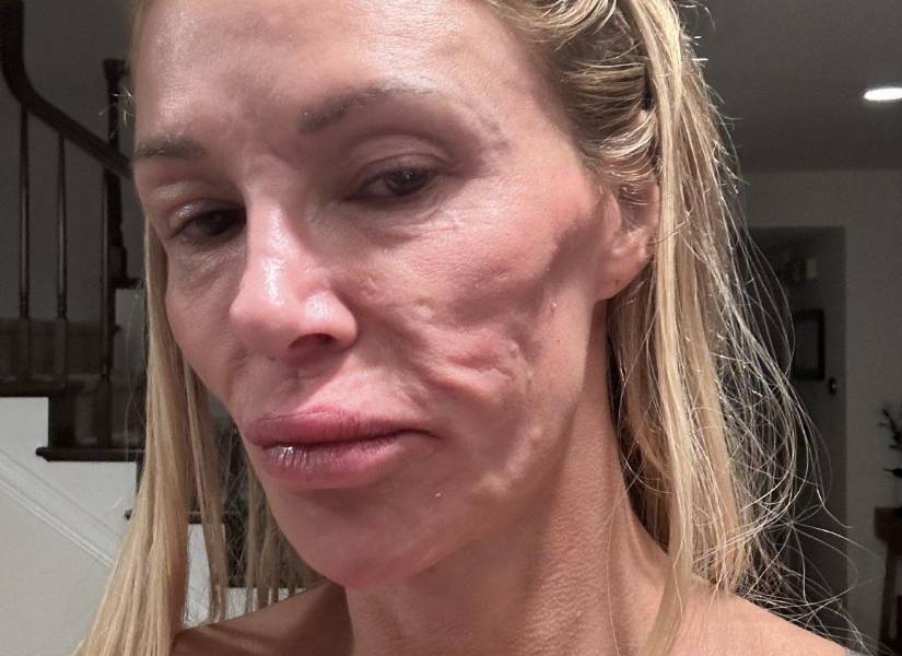 Brandi Glanville con su rostro afectado con por el parásito facial.