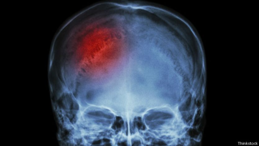 ¿Qué hace el cerebro para protegerse de los impactos?