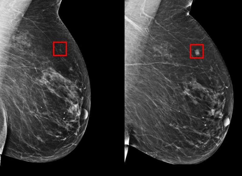 Imagen referencial sobre la detección del cáncer de mama.