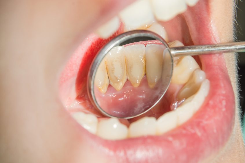 Bacterias de la boca pueden propagar el cáncer de colon, señala estudio