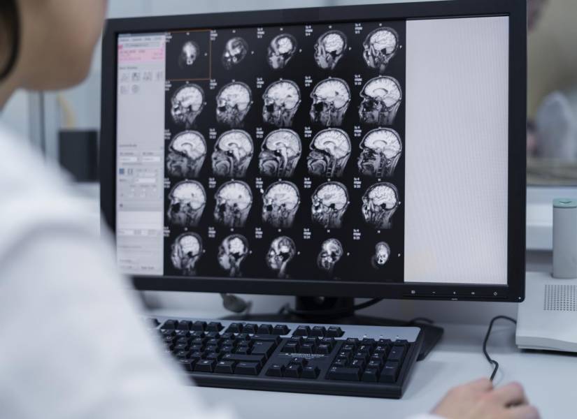 Foto referencia de una radiografía de cerebro.