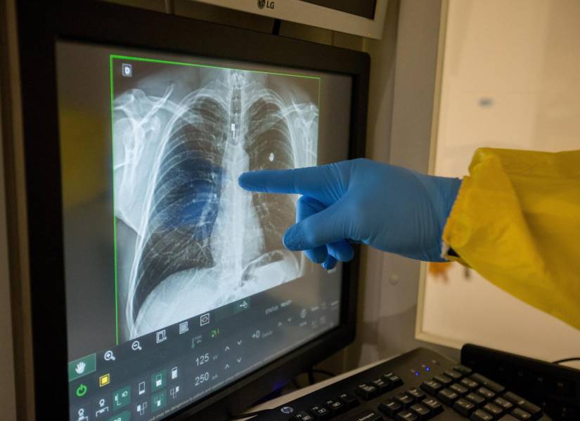 Garantizar el acceso a la salud respiratoria en América Latina sigue siendo un desafío, según reconocieron este jueves especialistas