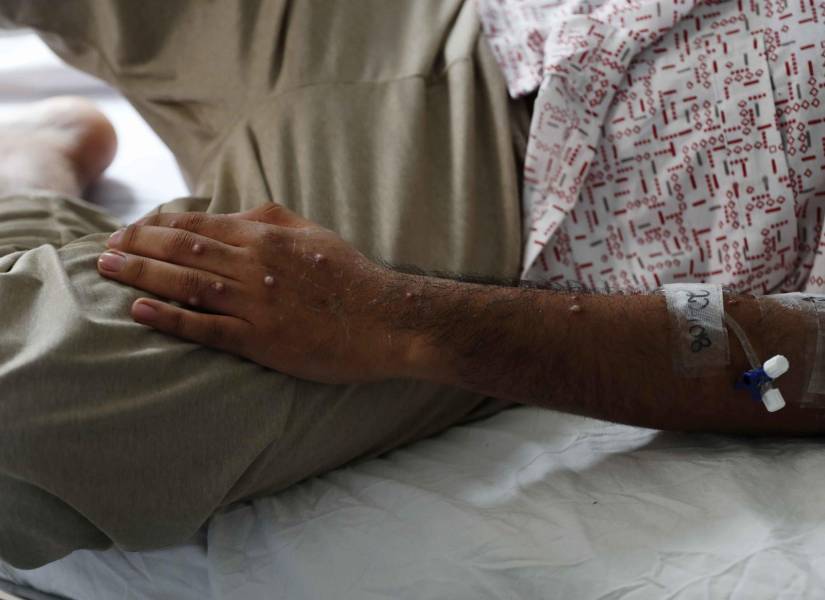 Un paciente es atendido tras ser diagnosticado con mpox, el 24 de agosto de 2022.