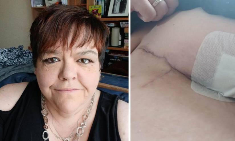 A Sylvia Halcrow le hallaron un absceso en su seno derecho.