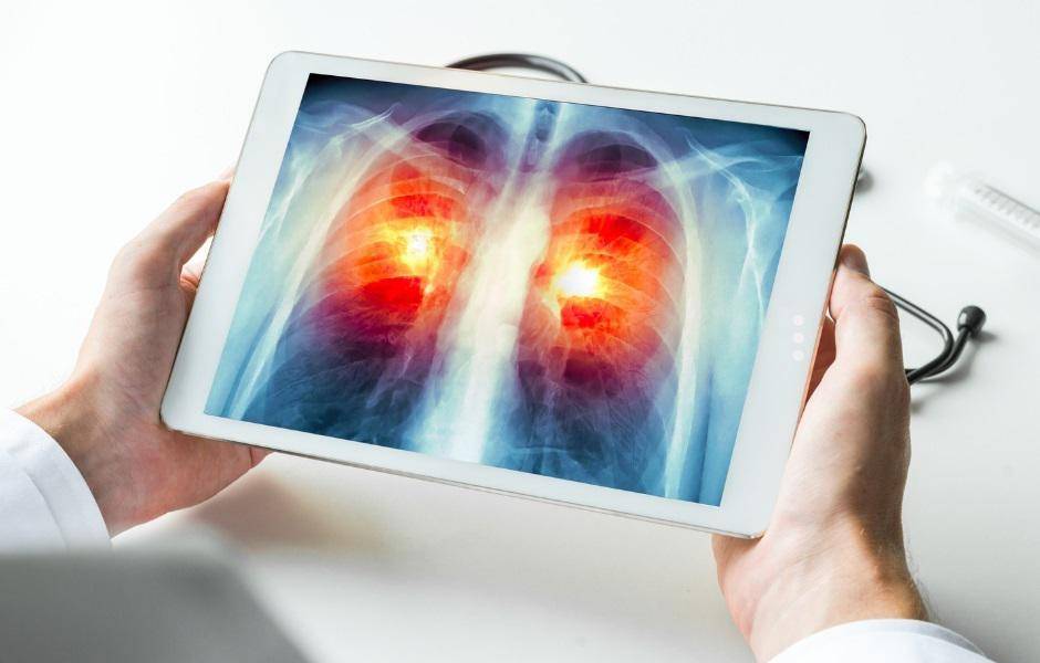 Cáncer de pulmón: este es el nuevo tratamiento que eleva el rango de supervivencia