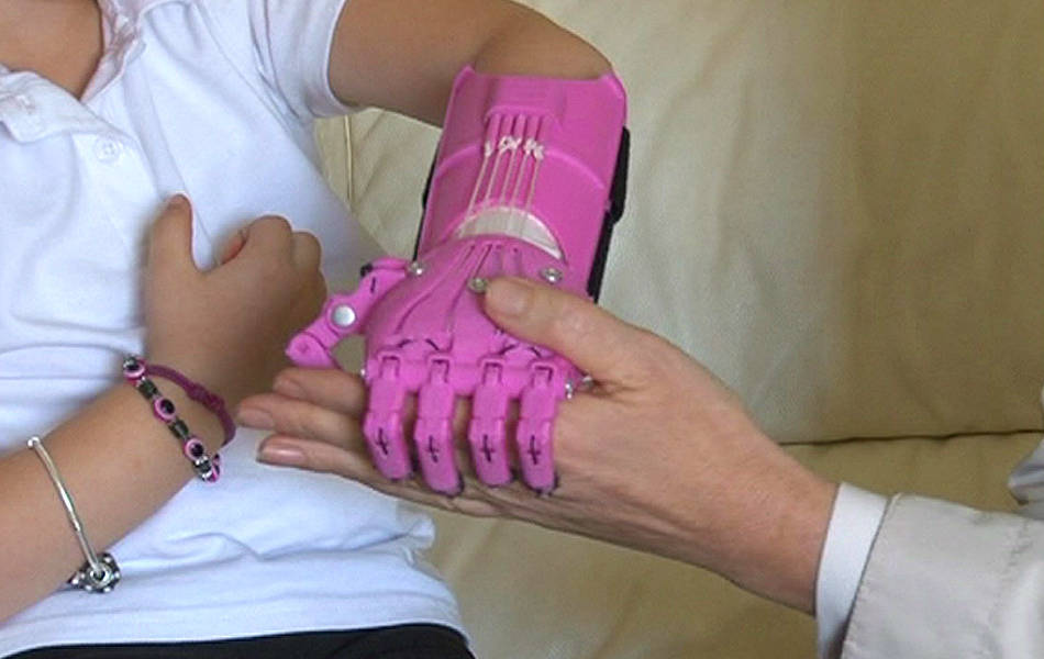 Vea en acción la mano impresa en 3D para una niña de 5 años