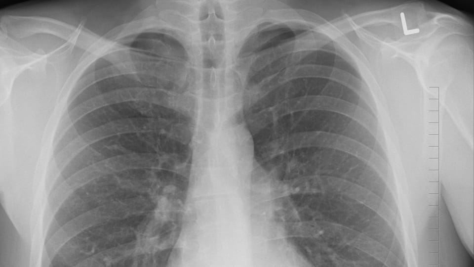 Enzima podría ser efectiva en tratamiento de tumores pulmonares