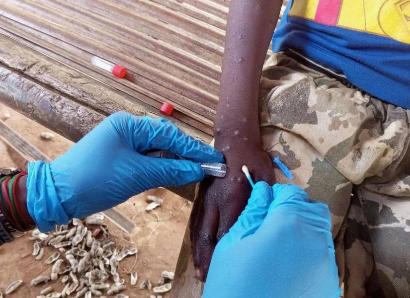 Imagen REFERENCIAL DE médico RECOGIENDO MUESTRA DE PÚSTULA GENERADA POR LA mpox.