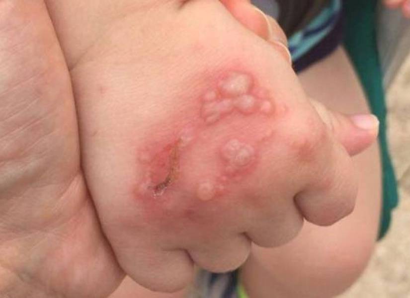 Imagen referencial que refleja el brote del virus de pies, manos y boca en niños.