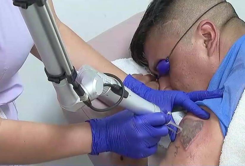 Imagen de un hombre en un proceso de remoción de tatuaje.